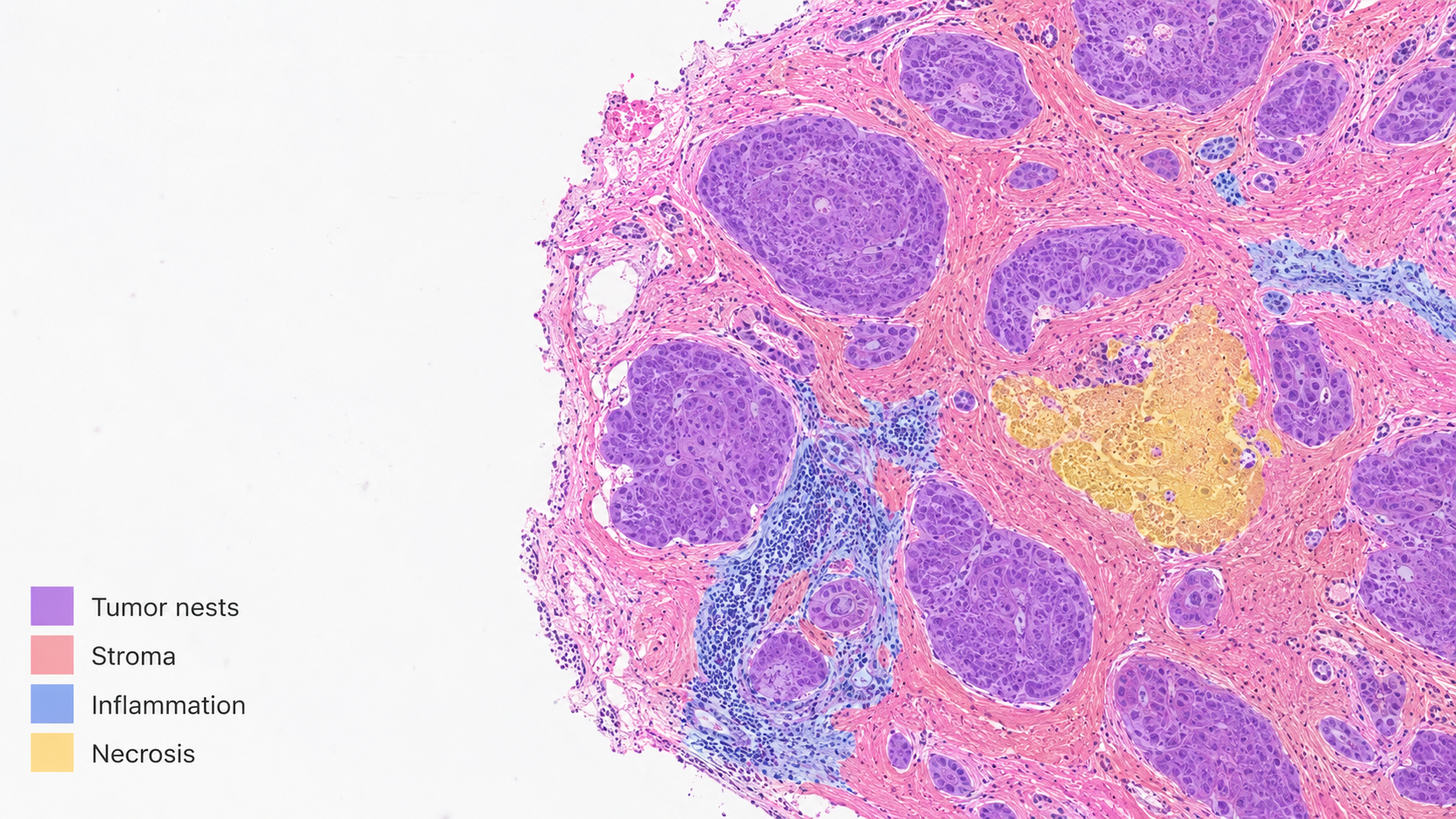 Breast cancer tissue segmentation
