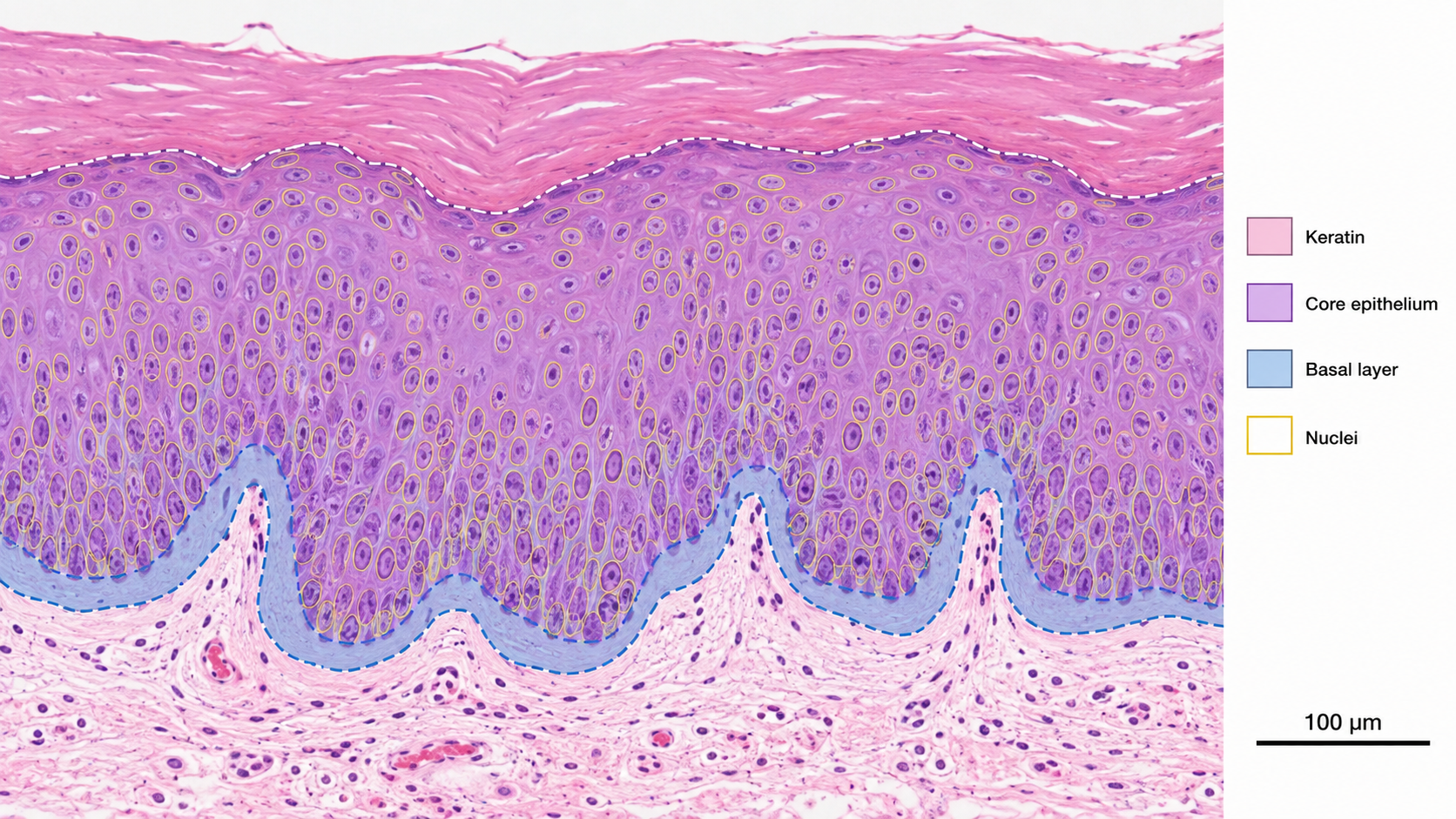 Oral epithelial dysplasia